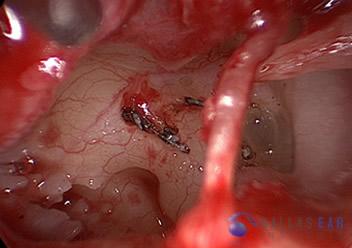 inner ear 3 (1)
