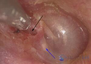 attic-cholesteatoma-1