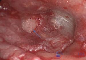 attic-cholesteatoma-10