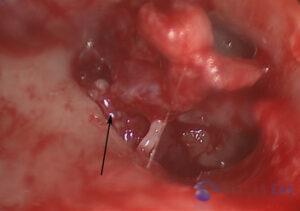 attic-cholesteatoma-2