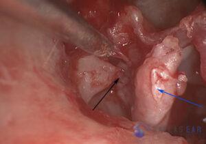 attic-cholesteatoma-3