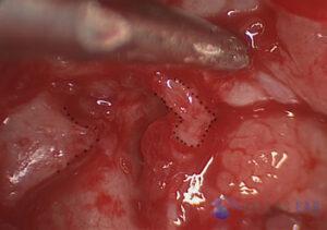 attic-cholesteatoma-4