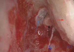 attic-cholesteatoma-5