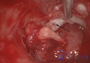 attic-cholesteatoma-6