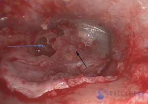 attic-cholesteatoma-8