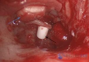 attic-cholesteatoma-9