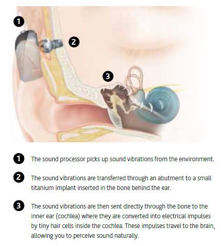 bone-anchored-hearing