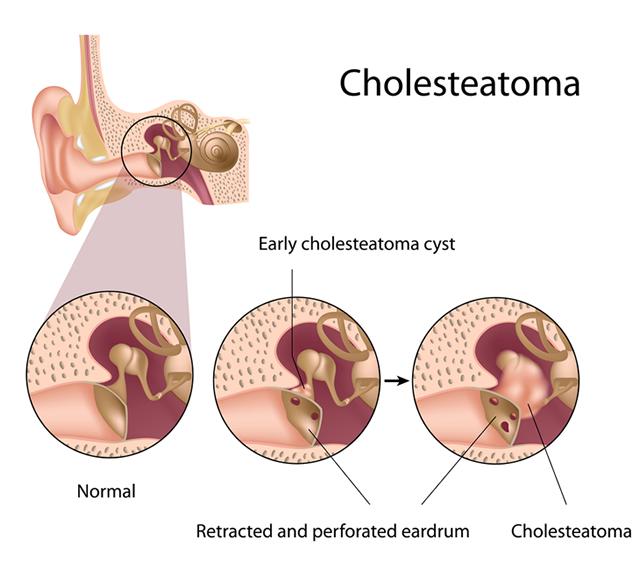 cholesteatoma