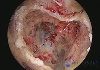 endolymphatic-sac-surgery-1