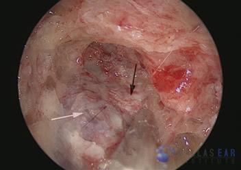 endolymphatic-sac-surgery-2