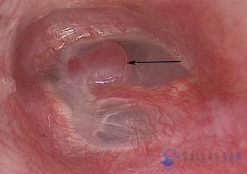 glomus-tumor-cases-1
