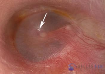 glomus-tumor-cases-2-1