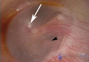 glomus-tumor-cases-2-2
