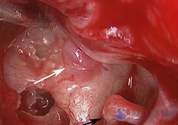 glomus-tumor-cases-2-3