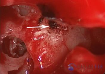 glomus-tumor-cases-2-4