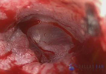 glomus-tumor-cases-2-5