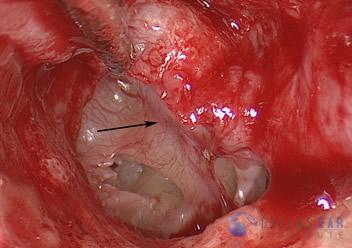 glomus-tumor-cases-2