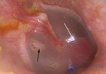 glomus-tumor-cases-3-1