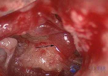 glomus-tumor-cases-3-2