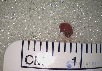 glomus-tumor-cases-3-3