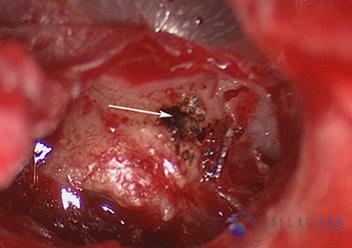 glomus-tumor-cases-3-4