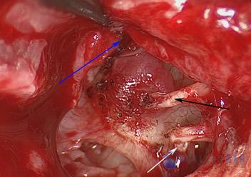 glomus-tumor-cases-3