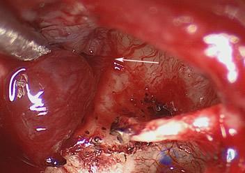 glomus-tumor-cases-4