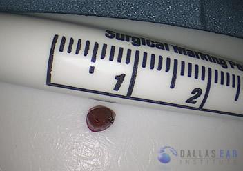 glomus-tumor-cases-5