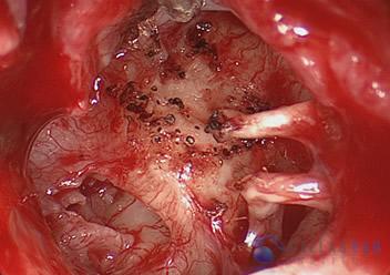 glomus-tumor-cases-6
