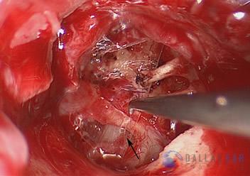 glomus-tumor-cases-7