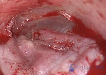 glomus-tumor-cases-8