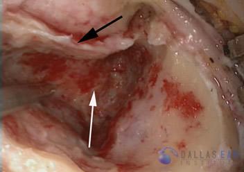 labyrinthectomy-cases-1