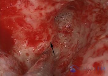labyrinthectomy-cases-2