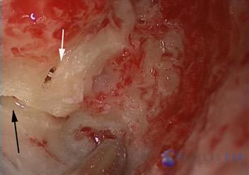 labyrinthectomy-cases-3