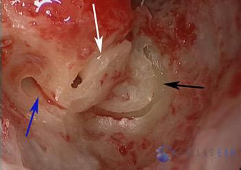 labyrinthectomy-cases-4