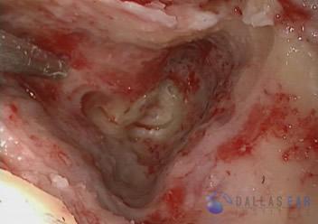 labyrinthectomy-cases-5