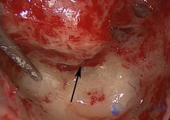 labyrinthectomy-cases-6