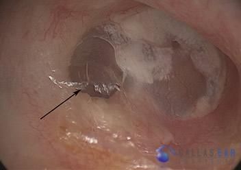 ossicular-chain-reconstruction-case-1
