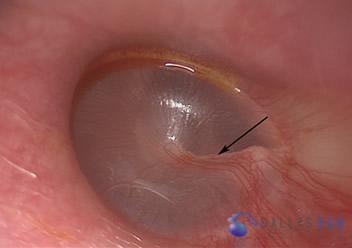 ossicular-chain-reconstruction-case-2-1