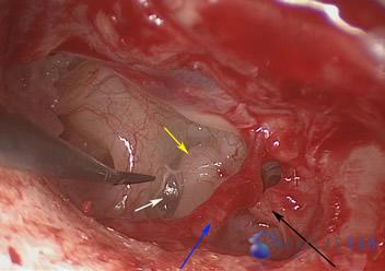 ossicular-chain-reconstruction-case-2-2