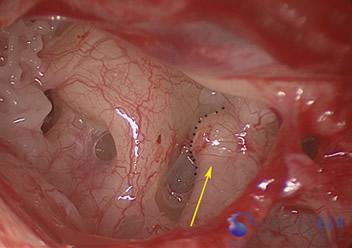 ossicular-chain-reconstruction-case-2-3