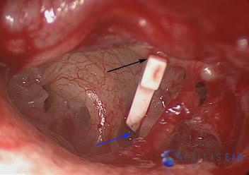 ossicular-chain-reconstruction-case-2-5