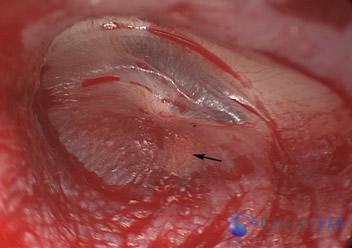 ossicular-chain-reconstruction-case-2-6