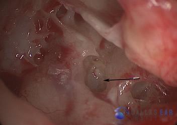 ossicular-chain-reconstruction-case-2