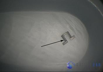ossicular-chain-reconstruction-case-3
