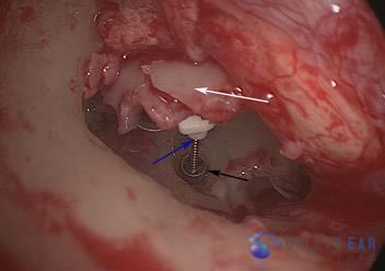 ossicular-chain-reconstruction-case-5