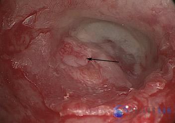 ossicular-chain-reconstruction-case-6