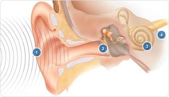 pic-cochlear-natural-hearing