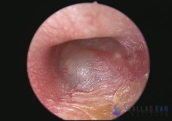 pic-ear-infection-cases