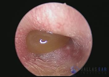 pic-ear-infection-cases1